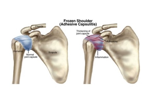 shoulder steroid injection procedure