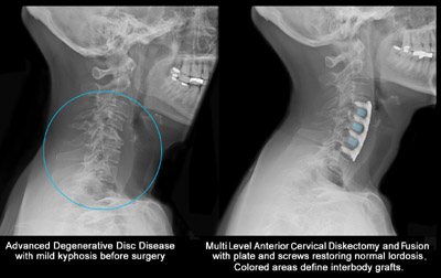 Spinal Disc Syndrome - Connecticut Family Chiropractic Center, Danbury